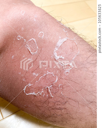 Peeling after sunburn 105633825