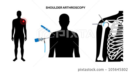 Shoulder arthroscopy poster 105645802