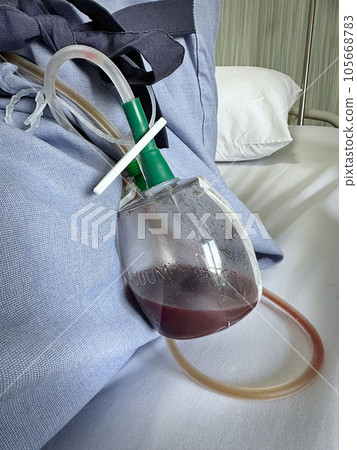 Vacuum Blood Draining Pot with Tube after Thyroidectomy 105668783