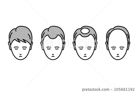 AGA,一名患有進行性脫髮的男子的插圖 AGA,一名患有進行性脫髮的男子的插圖 105681192