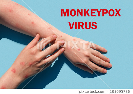 Phrase MONKEYPOX VIRUS on blue background and Patient with Monkey Pox. Monkeypox new disease dangerous over the world. Painful rash, red spots blisters. Close up human hands with Health problem 105695786