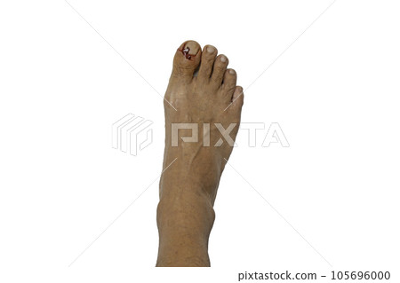 Bleeding from a wound on a man's foot from accidents at home, isolated on white background Bleeding from a wound on a man's foot from accidents at home, isolated on white background 105696000
