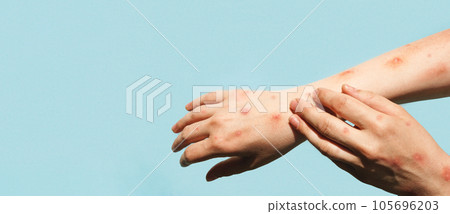 Monkeypox new disease dangerous over the world. Patient with Monkey Pox. Painful rash, red spots blisters on the hand. Close up rash, human hands with Health problem. Banner, copy space Monkeypox new disease dangerous over the world. Patient with Monkey Pox. Painful rash, red spots blisters on the hand. Close up rash, human hands with Health problem. Banner, copy space 105696203