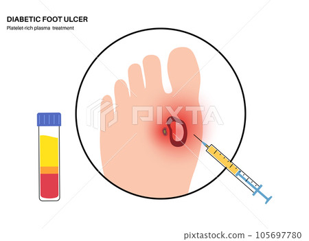 Diabetic Foot Ulcers 105697780