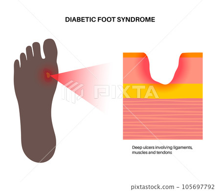 Diabetic Foot Ulcers Diabetic Foot Ulcers 105697792