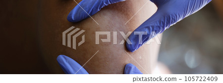 Doctor in latex gloves checkup unhealthy skin of male patient. 105722409