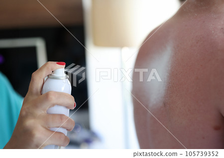 Apply sun protection cream to sunburned back 105739352