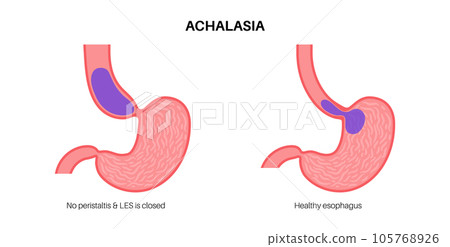Esophageal achalasia disease Esophageal achalasia disease 105768926