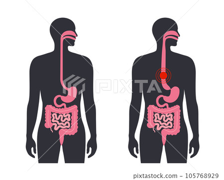 Esophageal achalasia disease Esophageal achalasia disease 105768929
