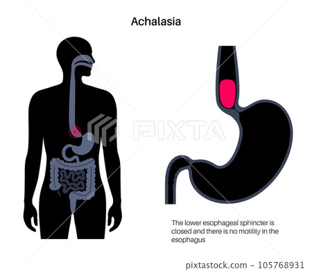 Esophageal achalasia disease Esophageal achalasia disease 105768931