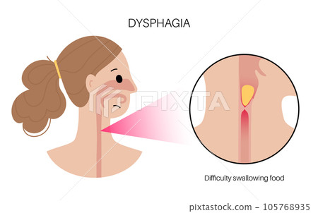 Dysphagia medical poster 105768935