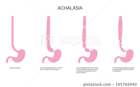 Esophageal achalasia disease Esophageal achalasia disease 105768940
