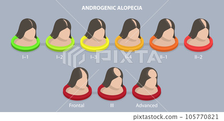 3D Isometric Flat Vector Conceptual Illustration of Androgenic Alopecia 105770821