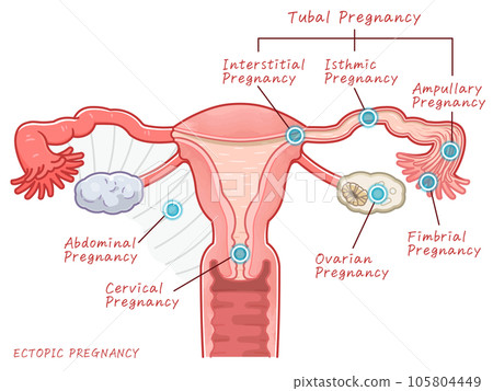 宮外孕 子宮 卵巢 插圖 宮外孕 子宮 卵巢 插圖 105804449