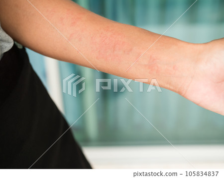 Hand woman non-lethal type from food and air poisoning. she apply Calamine Lotion medicine on the arm her.she Sick, have an allergic reaction. Urticaria on skin body.healthcare concept. Hand woman non-lethal type from food and air poisoning. she apply Calamine Lotion medicine on the arm her.she Sick, have an allergic reaction. Urticaria on skin body.healthcare concept. 105834837