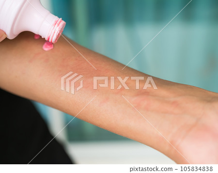 Urticaria on hand woman non-lethal type from food and air poisoning. she apply Calamine Lotion medicine on the arm her.she Sick, have an allergic reaction. Urticaria on skin body.healthcare concept. Urticaria on hand woman non-lethal type from food and air poisoning. she apply Calamine Lotion medicine on the arm her.she Sick, have an allergic reaction. Urticaria on skin body.healthcare concept. 105834838