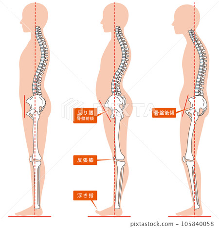 Posture comparison of arched back and posterior Stock