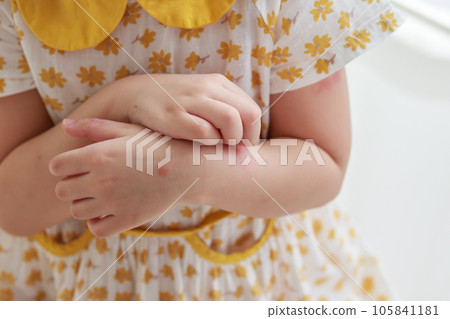 Little girl has skin rash allergy itching and scratching on her arm 105841181