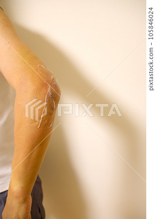 elbow fracture surgery scar elbow fracture surgery scar 105846024
