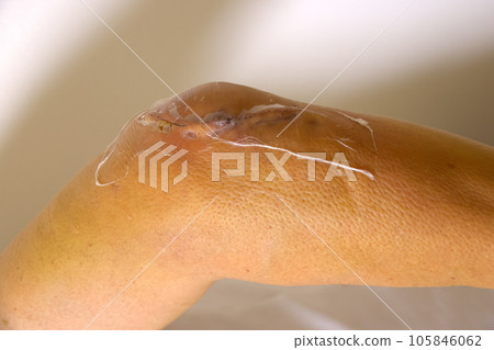 肘部骨折手術疤痕 肘部骨折手術疤痕 105846062