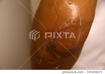 elbow fracture surgery scar 105846071