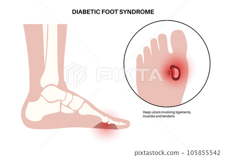 Diabetic Foot Ulcers Diabetic Foot Ulcers 105855542
