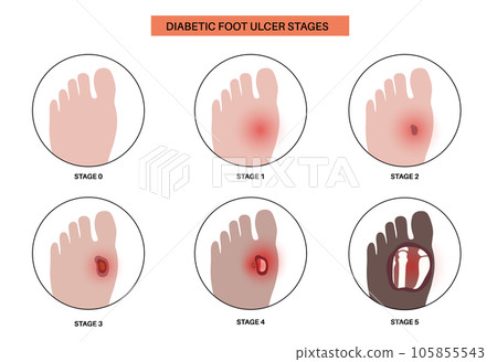Diabetic Foot Ulcers Diabetic Foot Ulcers 105855543