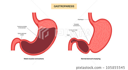 Gastroparesis anatomical poster Gastroparesis anatomical poster 105855545