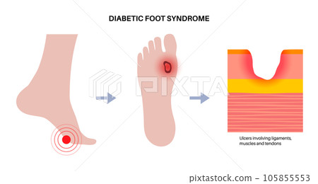 Diabetic Foot Ulcers 105855553