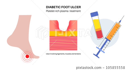 Diabetic Foot Ulcers 105855558