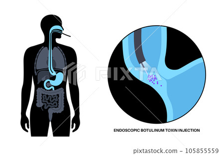 esophageal botulinum toxin injection 105855559