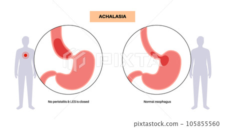 Esophageal achalasia disease 105855560