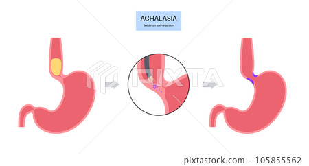 esophageal botulinum toxin injection 105855562
