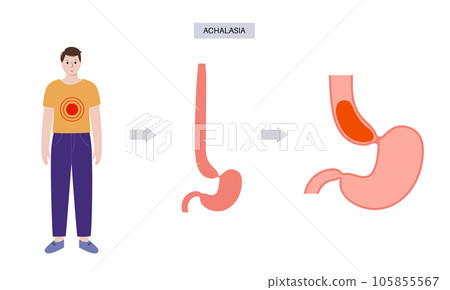 Esophageal achalasia disease Esophageal achalasia disease 105855567