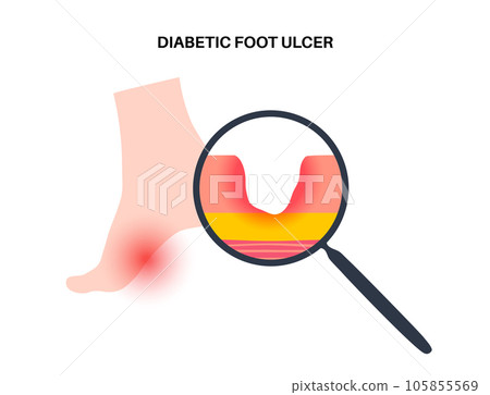 Diabetic Foot Ulcers 105855569