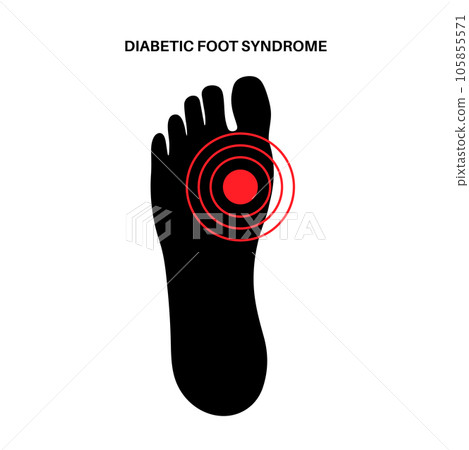 Diabetic Foot Ulcers 105855571