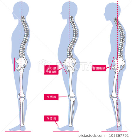 Posture comparison of arched back and posterior tilt of the pelvis Posture comparison of arched back and posterior tilt of the pelvis 105867791