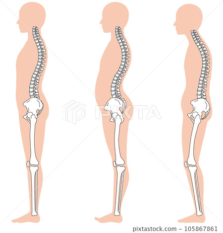 弓背與骨盆後傾姿勢對比 弓背與骨盆後傾姿勢對比 105867861