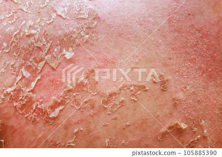 In field of dermatology, psoriatic eczema presents unique challenges for diagnosis treatment. 105885390