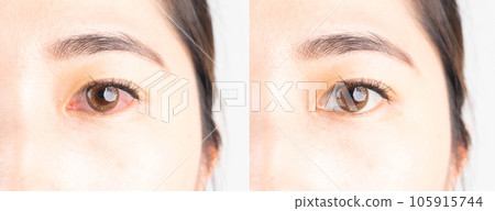 Before and after treatment red eye. Cause of red eye include conjunctivits, bacterial infection, dry eye, eye injury, allergies and over wearing contact lenses. Before and after treatment red eye. Cause of red eye include conjunctivits, bacterial infection, dry eye, eye injury, allergies and over wearing contact lenses. 105915744