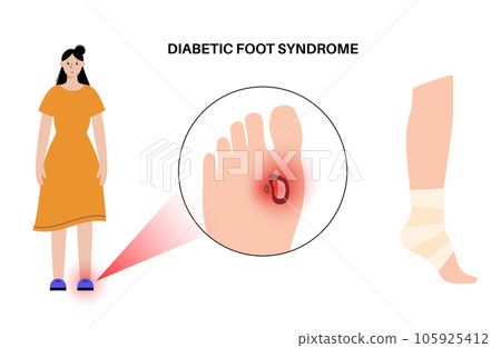Diabetic Foot Ulcers Diabetic Foot Ulcers 105925412