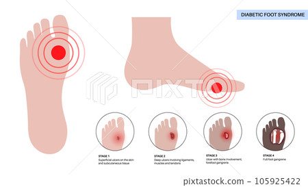 Diabetic Foot Ulcers 105925422
