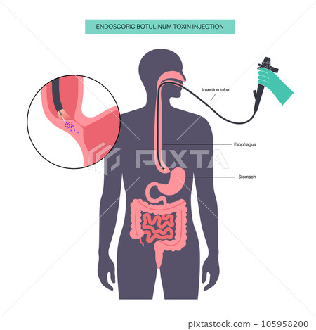 esophageal botulinum toxin injection 105958200
