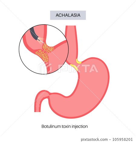 esophageal botulinum toxin injection 105958201