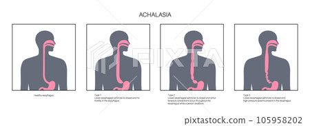 Esophageal achalasia disease Esophageal achalasia disease 105958202