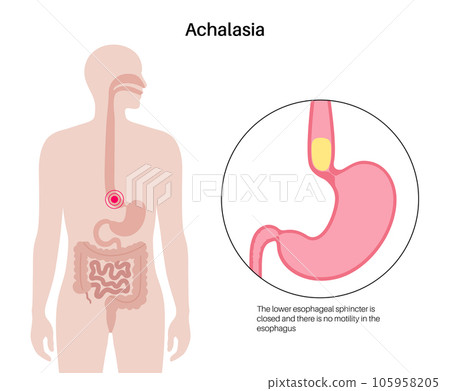 Esophageal achalasia disease 105958205