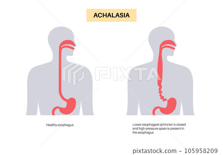 Esophageal achalasia disease Esophageal achalasia disease 105958209
