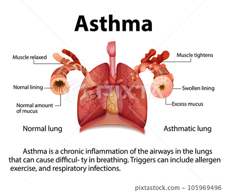 Comparing Normal and Asthma Lungs in Medical Education 105969496