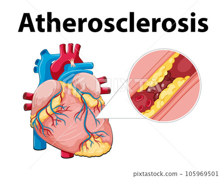 Science of Human Anatomy and Atherosclerosis Development 105969501