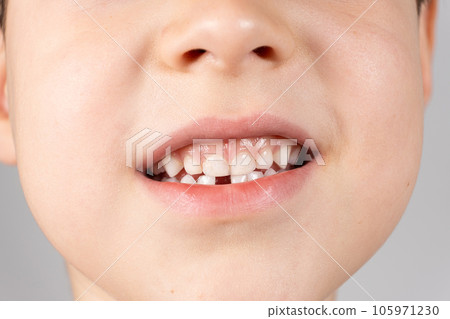 Loss of milk teeth in children. A six-year-old child shows the first baby tooth that has fallen out Loss of milk teeth in children. A six-year-old child shows the first baby tooth that has fallen out 105971230
